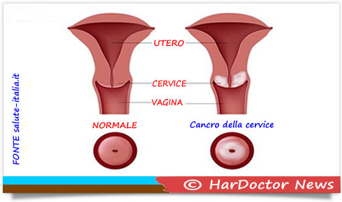 Cancro colon sintomi