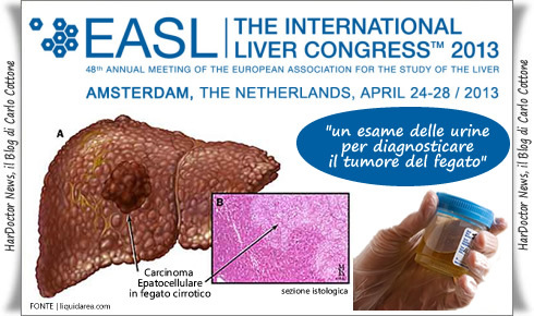 Tumore Al Fegato Un Esame Delle Urine Per La Diagnosi